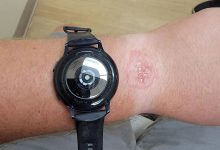 Фото - Умные часы Samsung Galaxy Watch оставили ожог на руке владельца во время сна