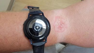 Фото - Умные часы Samsung Galaxy Watch оставили ожог на руке владельца во время сна