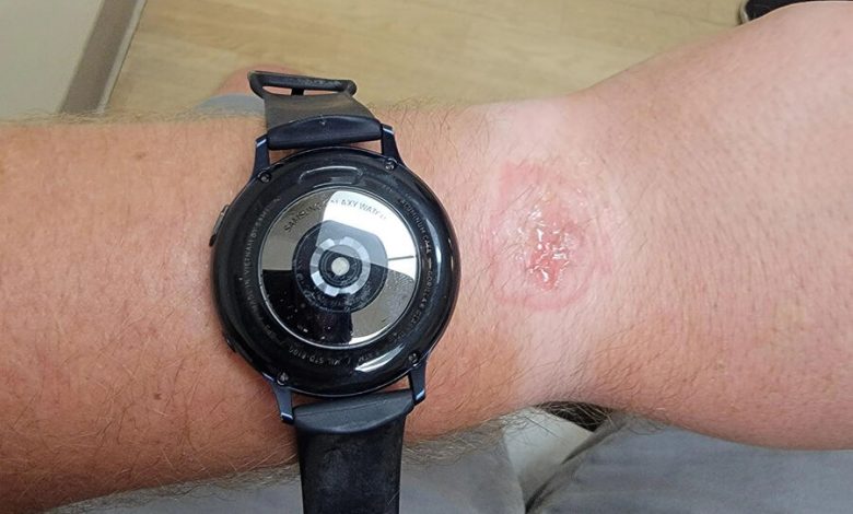 Фото - Умные часы Samsung Galaxy Watch оставили ожог на руке владельца во время сна